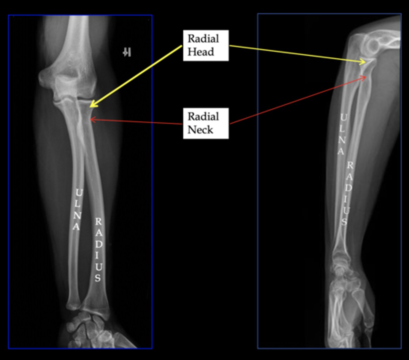 <p>The head of the radius is relatively small compared to its distal epiphysis, while the ulna's proximal region is larger than its distal region.</p>