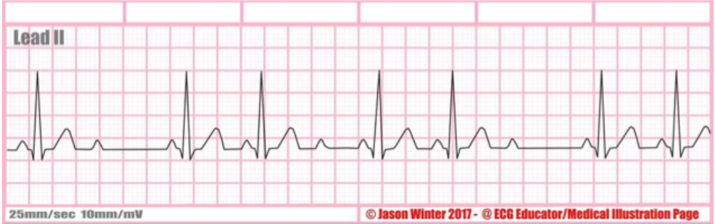 <p>type of abnormality + characteristics?</p>