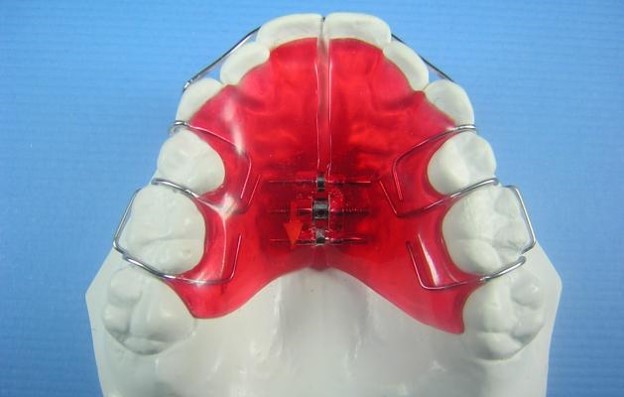 <p>Passive when holding teeth in new position</p><p>But becomes active when using screws to move teeth</p><p>5mm</p><p>Distal of the canine</p>