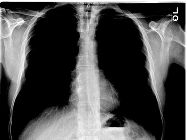 <ul><li><p>Should be <strong>able to see T4 (not T5)</strong> <strong>vertebrae</strong> on PA</p></li><li><p>Over-exposed = appears black</p></li><li><p>Under-exposed = appears falsely white</p></li></ul><p></p>