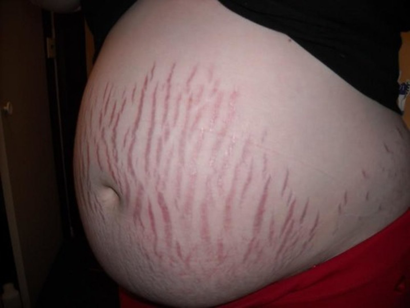 <p>Reddish lines known as striae gravidarum</p>
