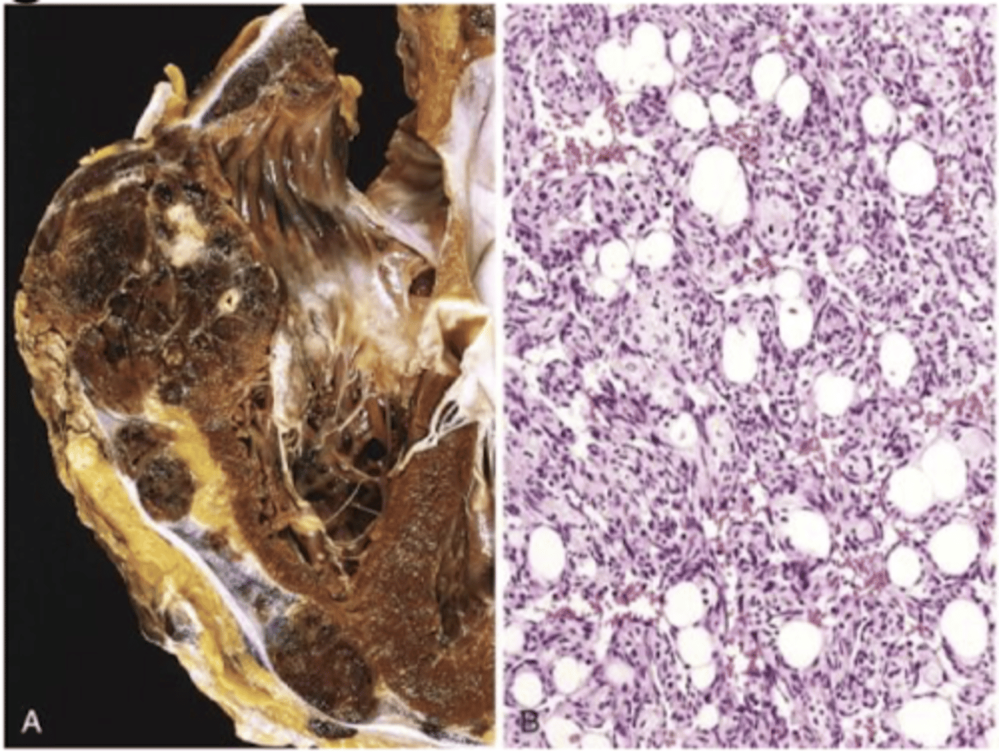 <p>starts as small papule</p><p>progresses to large, fleshy red tan to gray white lesions with blurred margins, necrosis, hemorrhage</p>