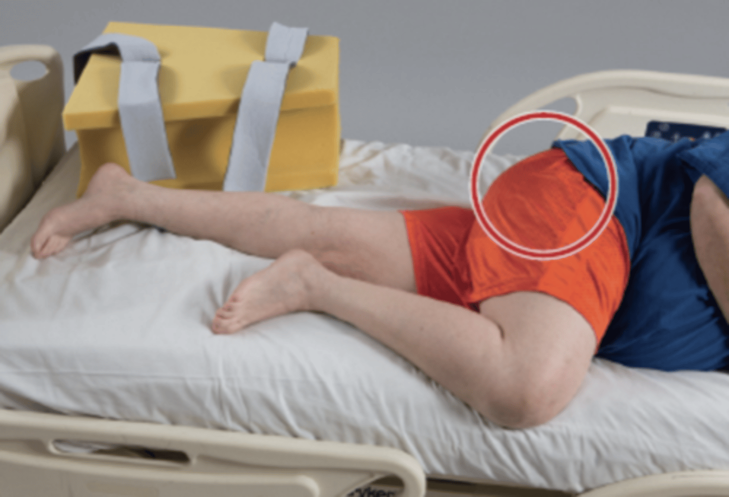 <p>In sidelying, the uppermost leg, whether lying directly on top or forward of the leg beneath it, naturally moves into hip adduction, violating the movement precautions for a patient with a total hip arthroplasty via a posterolateral approach.</p>