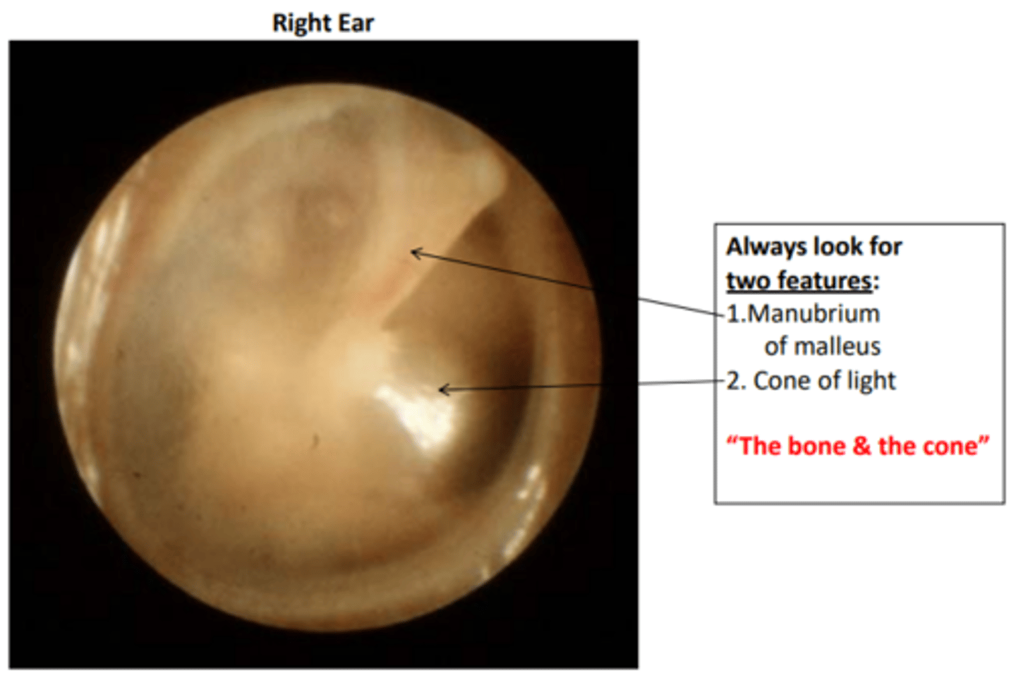<p>1. Manubrium of malleus </p><p>2. Cone of light </p><p>“The bone &amp; the cone”</p>