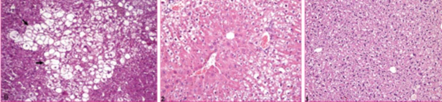 <p>clear granules, vacuoles</p><p>less sharply defined than lipid and less likely to displace nucleus</p>