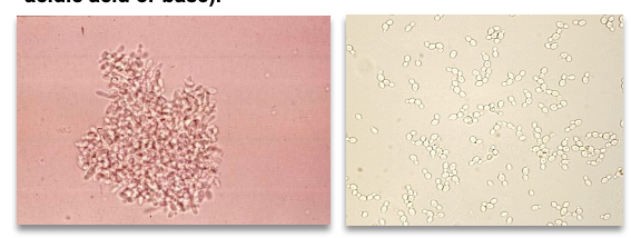 <ul><li><p class=""><strong>Small, refractile ovals</strong>; may show <strong>budding</strong> or <strong>hyphae</strong></p></li><li><p class="">Common species: <strong>Candida albicans</strong></p></li><li><p class="">Often seen in:</p><ul><li><p class=""><strong>Diabetes mellitus</strong> (acidic, glucose-rich urine)</p></li><li><p class=""><strong>Immunocompromised patients</strong></p></li><li><p class=""><strong>Vaginal yeast infections</strong></p></li></ul></li><li><p class="">May be a <strong>contaminant</strong>; rapid growth → interpret with caution</p></li><li><p class=""><strong>WBCs should be present</strong> if infection is true</p></li><li><p class=""><strong>Differentiation tip</strong>: Yeast <strong>resists acid/base</strong>, RBCs do not</p></li></ul><p></p>
