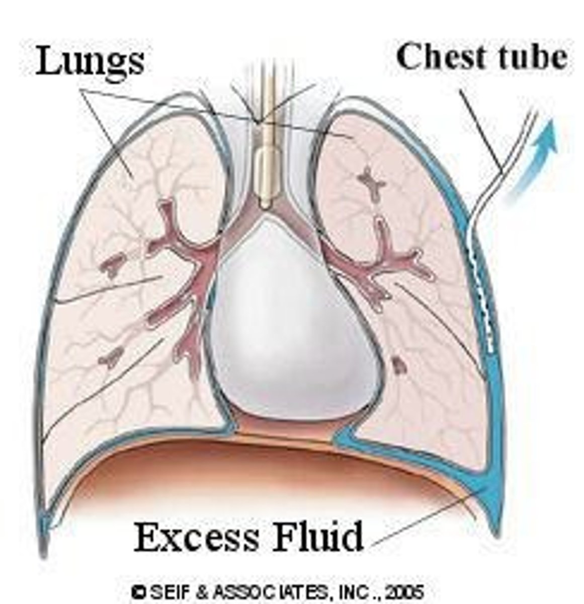 <p>To remove air, fluid, or blood to restore negative intrapleural pressure.</p>