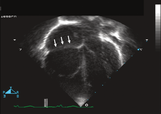 <p>Atrialized portion of RV that is continuous with true RA</p><p>Apical displacement of the septal and posterior leaflets of the TV into the RV. </p>