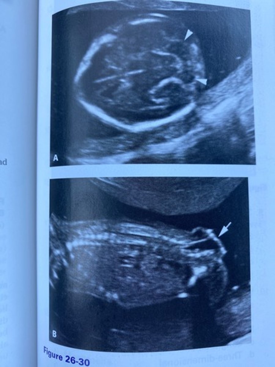 <p>What diagnosis is evident in Figure 26-30?</p><p>a. Spina bifida occulta with Dandy-Walker syndrome</p><p>b. Spina bifida aperta with Arnold-Chiari I malformation</p><p>c. Spina bifida occulta with Arnold-Chiari I malformation</p><p>d. Spina bifida aperta with Arnold-Chiari II malformation</p>
