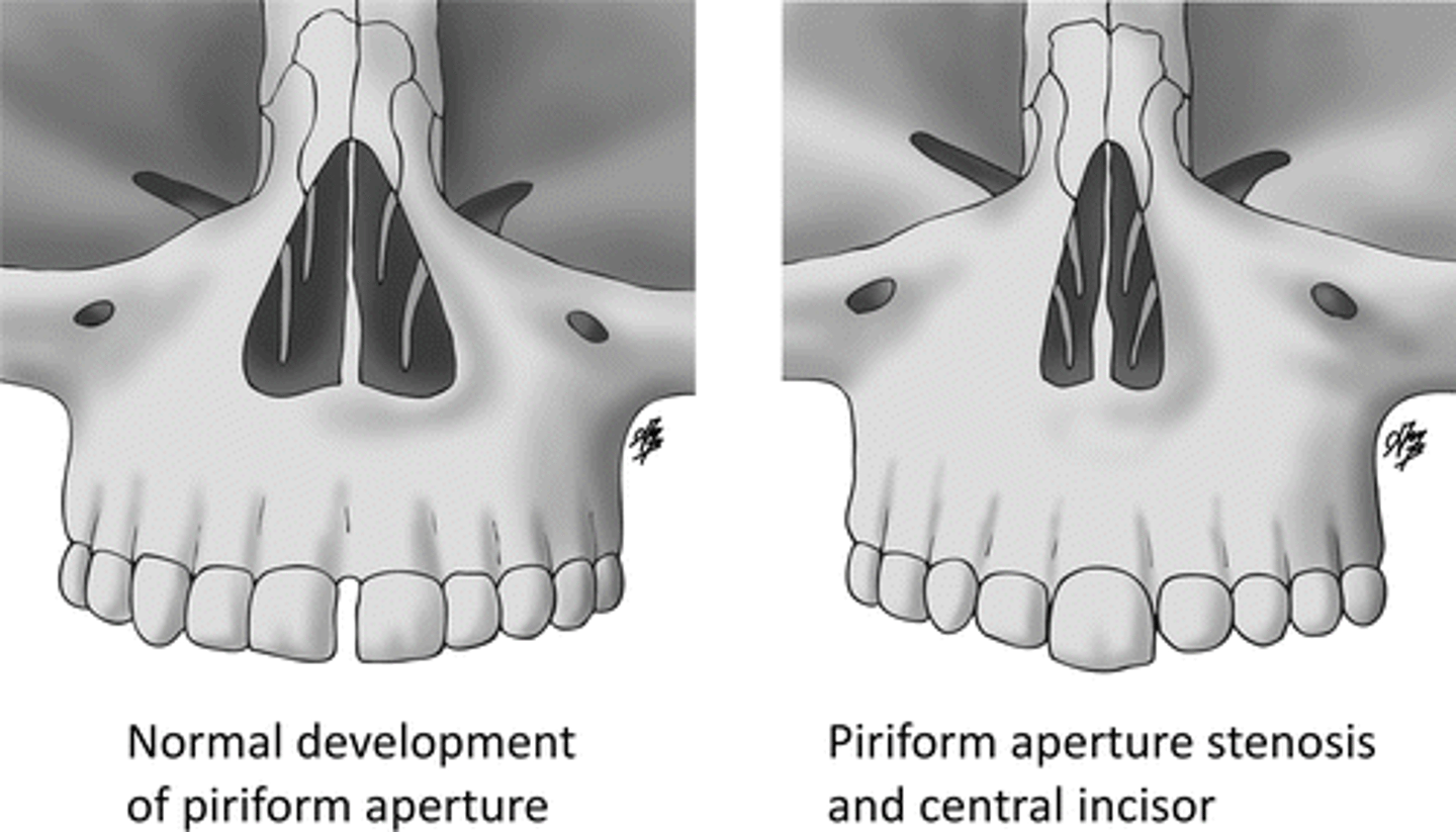 <p>Dz: Bony overgrowth at anterior bony opening</p><p>Sx: </p><p>-Noisy breathing</p><p>-Respiratory distress worsened with feeding, better when crying</p><p>Seen with: </p><p>-Craniosynostosis </p><p>-Pituitary anomalies</p><p>Dx: CT confirms</p><p>Tx: Nasal stenting or tracheostomy/surgery</p>
