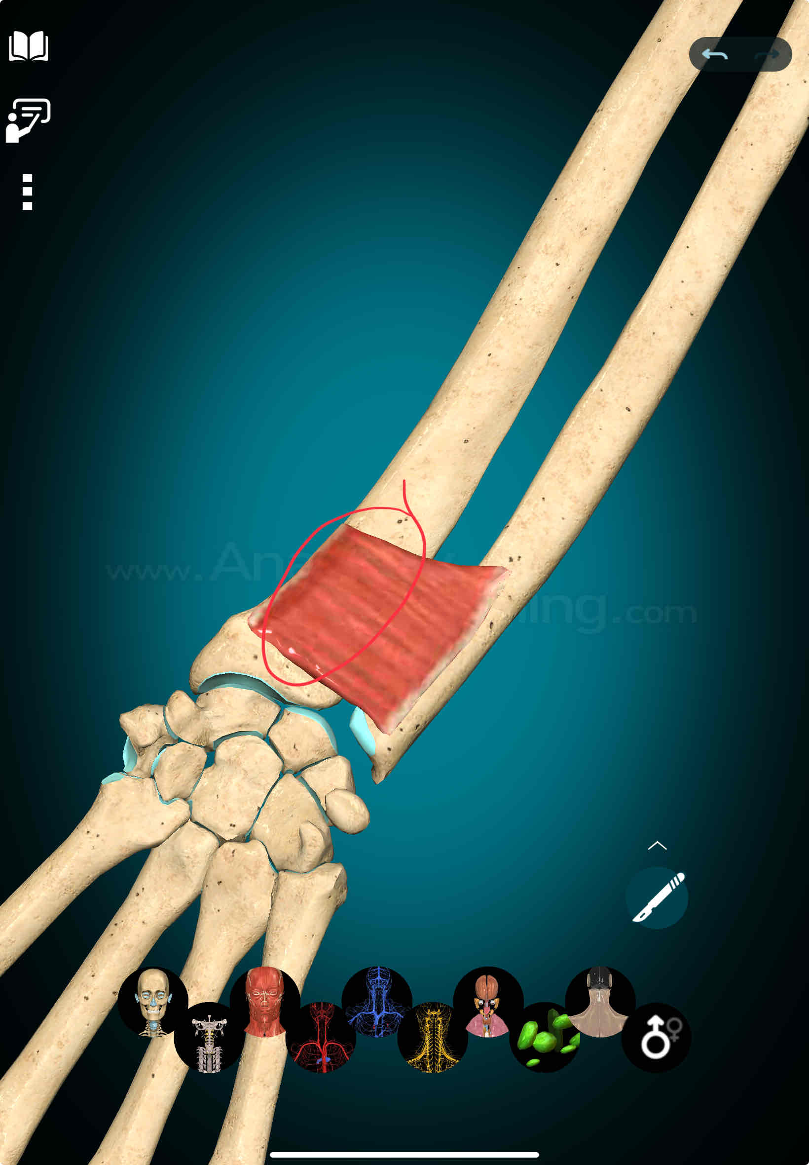 <p>Pronator Quadratus Insertion</p>
