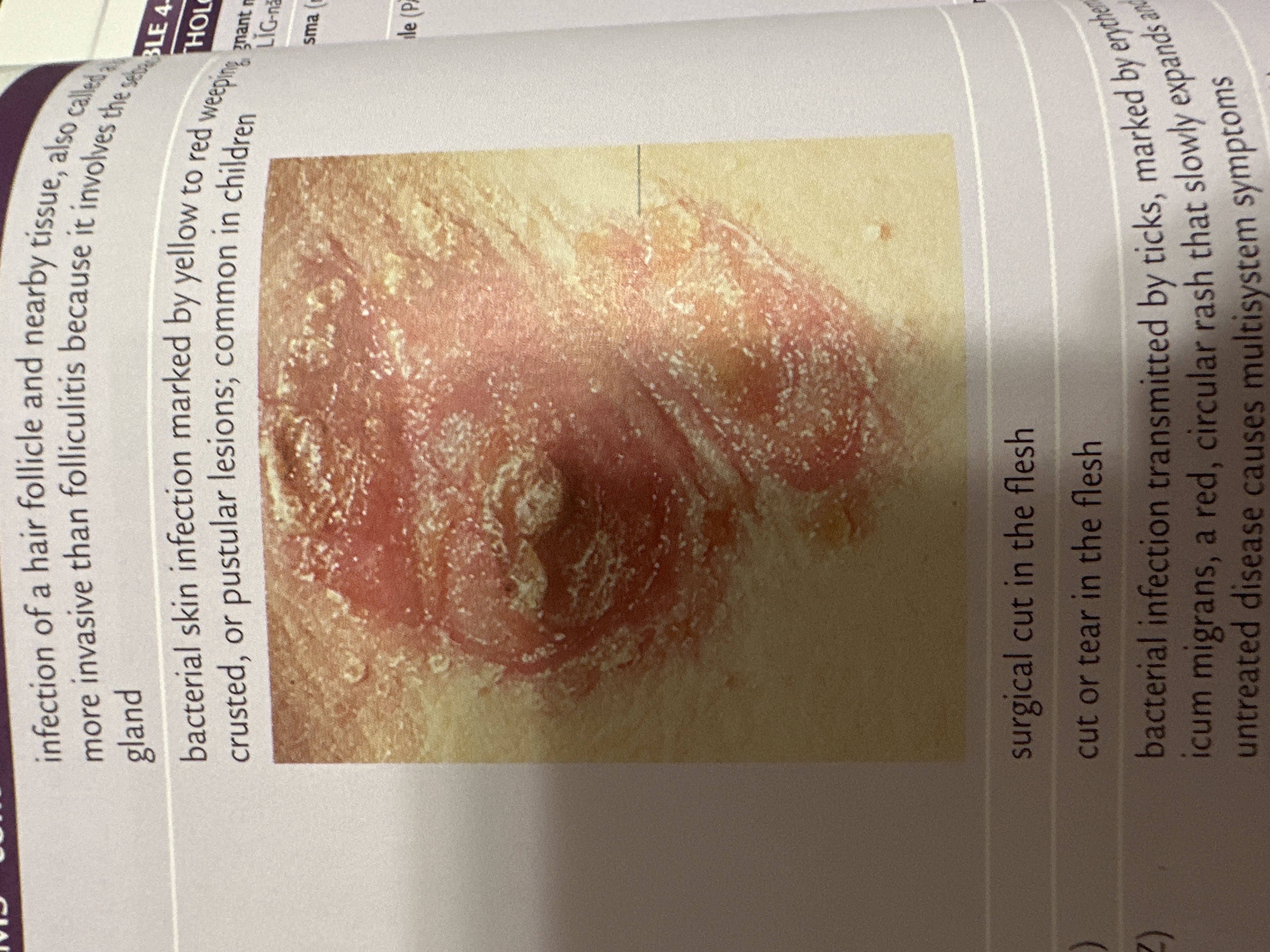 bacterial skin infection marked by yellow to red weeping, crusted, or pustular lesions; common in children
