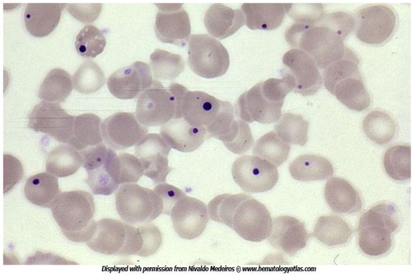<p>-are basophilic remnants of the nucleus that appear as small black pellets in RBCs. They are seen in pts with a history of spenectomy or functional asplenia</p><p>-HJ bodies are not seen in healthy individuals as normal spleen efficiently removes them</p>