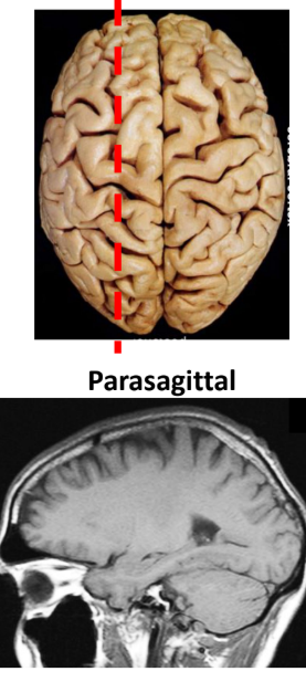 <p>Parasagittal</p>
