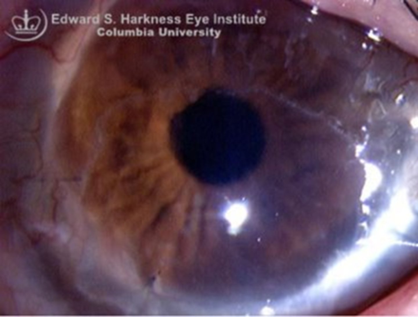 <p>What sign of graft rejection, a complication of PKP, is seen here?</p>