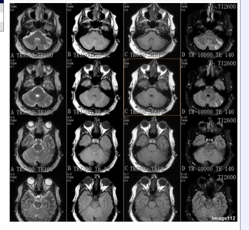 <p><span>&nbsp;Column A in Image 112 corresponds to which MRI pulse sequence?</span></p><p><span>&nbsp;A. Proton density</span></p><p><span>&nbsp;B. T1 weighted</span></p><p><span>&nbsp;C. T2 weighted</span></p><p><span>&nbsp;D. T2 FLAIR</span></p><p><span>&nbsp;E. T2 weighted with fat suppression</span></p><p><span>&nbsp;F. T2* gradient echo</span></p>
