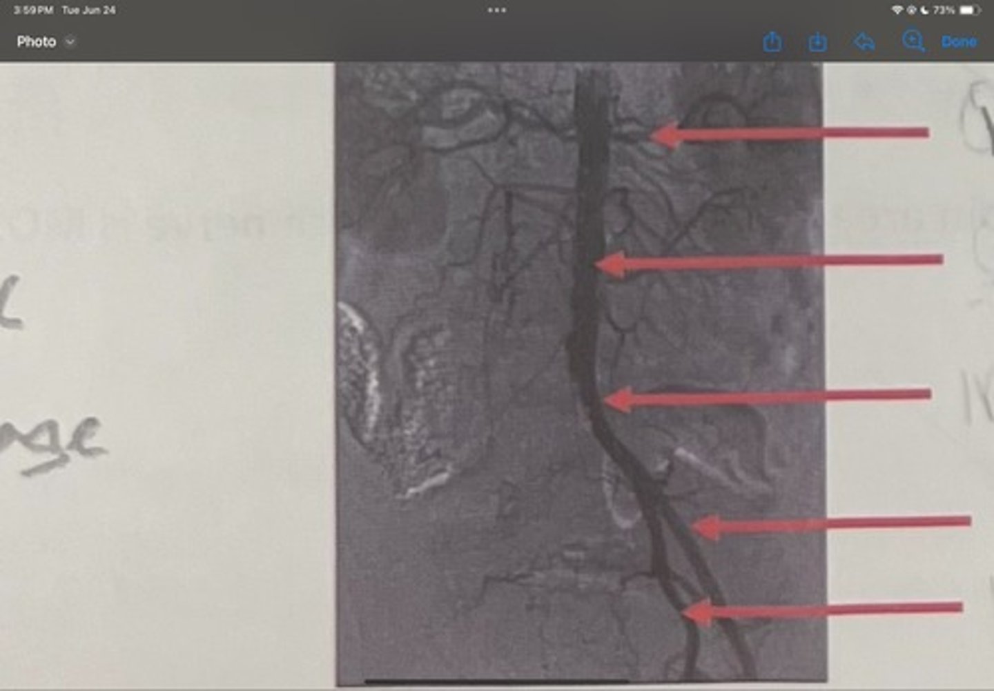 <p>What is the pathology of the image</p>