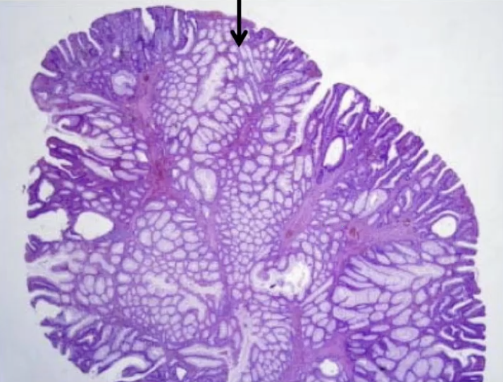 <p>Smooth muscle arborizing polyp =</p>
