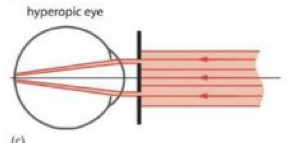 <p>What image will an hyperope produce as a result of the Scheiner principle?</p>