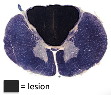 <p>(rare)</p><p>loss of proprioceptive sensation, fine touch, pressure, and vibration below the lesion</p>