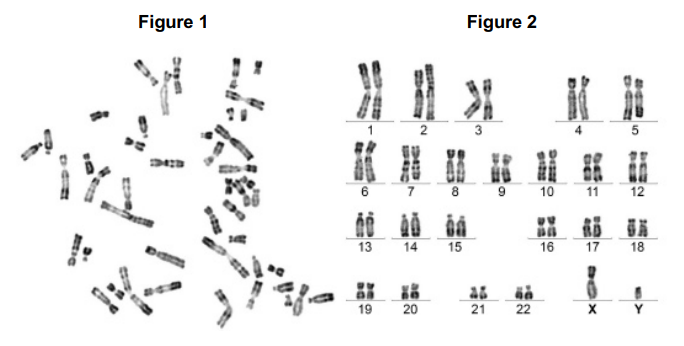 <p><strong>Figure 1</strong> shows all the chromosomes present in one human cell during mitosis. A scientist stained and photographed the chromosomes. In <strong>Figure 2</strong>, the scientist has arranged the images of these chromosomes in homologous pairs.</p><p>Give <strong>two</strong> pieces of evidence from <strong>Figure 1</strong> that this cell was undergoing mitosis. Explain your answers.(2) </p>