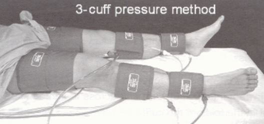 <p>Use of one large (17-19 x 40 cm) thigh cuff with normal thigh pressure<strong> EQUAL</strong> to brachial pressure</p>