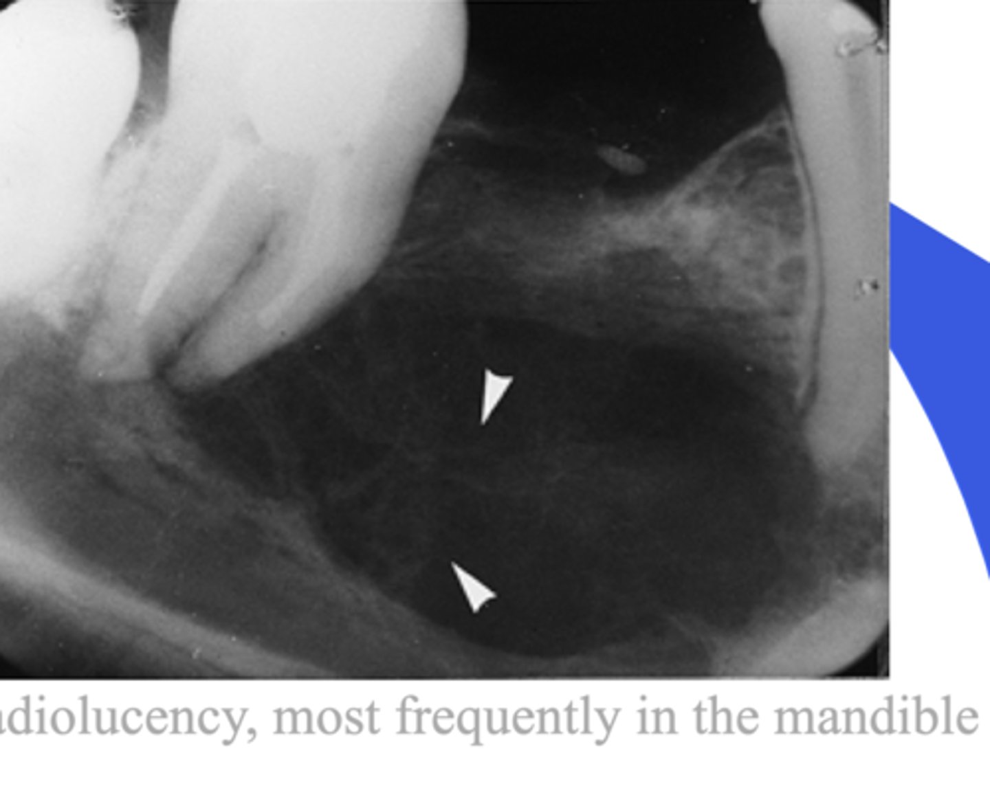 <p>- RL --&gt; will keep growing if left alone</p><p>- Always check tooth vitality</p><p>- Beehive combe (multilocular)</p><p>- more common in younger pts</p>