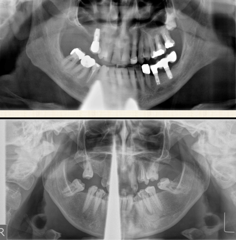 <p>Because of the beam’s upward projection from behind the patient during production of the pano- it obscures the anterior mandible </p>