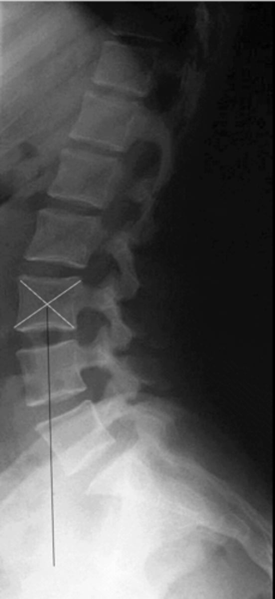 <p>How is the lumbar gravity line drawn?</p>