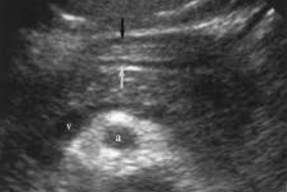 <p>The arrows point to a structure that is often times mistaken for the pancreatic duct, what is it actually? </p>
