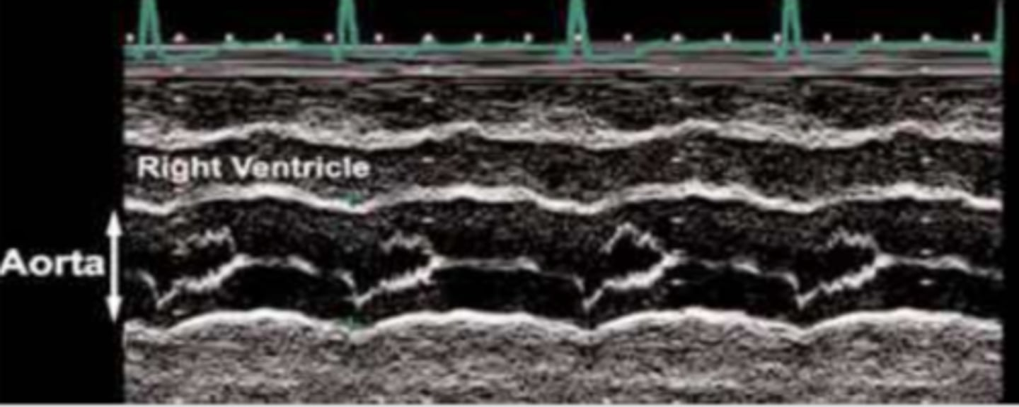 <p>AoV closes early; noted with hypertrophic cardiomyopathies, like idiopathic hypertrophic sub-aortic stenosis; decreased pressure for LV to aorta</p>