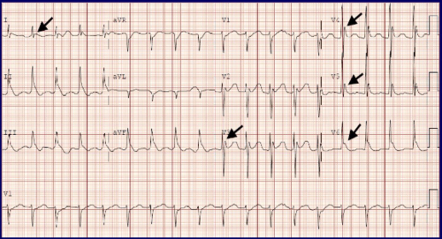 <p>Osborne J-wave</p><p>-occurs near J-point on the S wave and ST junction</p>
