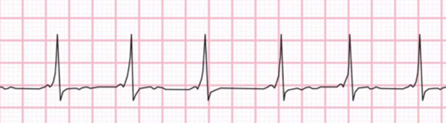 <p>What is the rhythm</p>