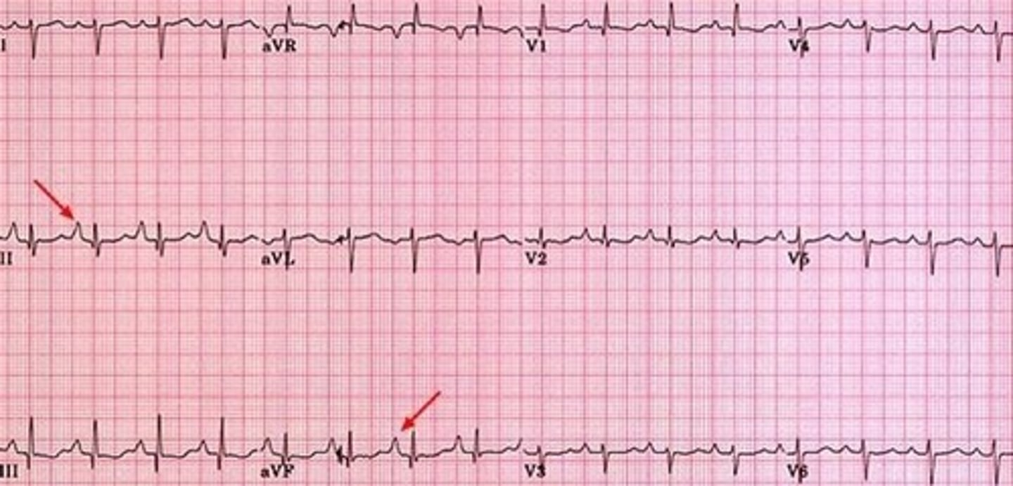<p>very tall P wave in right sided leads</p>