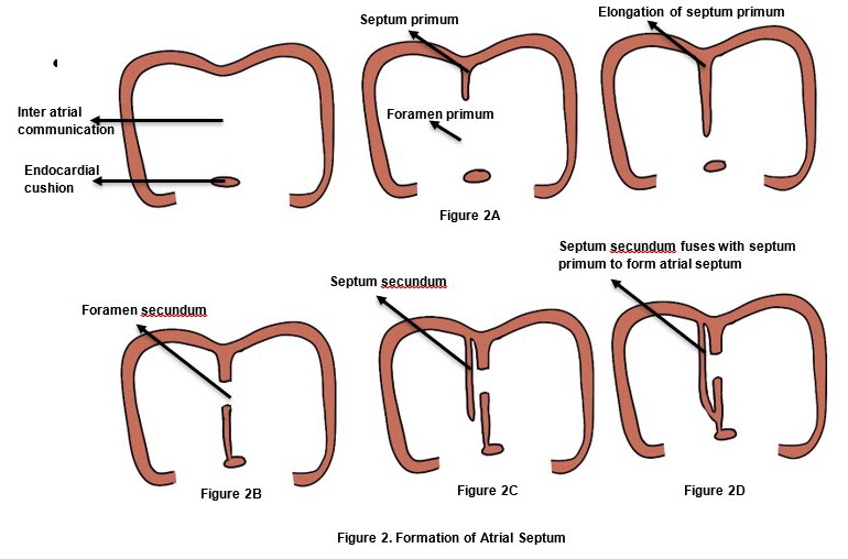 <p><span>Failure of septum primum and septum secundum to fuse after birth (right tp left shunt+paradoxical emboly)</span></p>