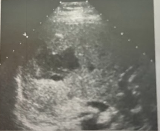 <p>A 38 year old woman undergoes a sonogram of the liver. She was seen in the ED 3 days earlier for severe RUQ pain. At that time CT scan was done, which showed a liver lesion that contained fresh blood. The pt had been taking oral contraceptives. Today’s exam shows a 6.5 × 5.5 cm heterogeneous, complex, cystic-appearing mass. Given pt hx and clinical presentation, what is the most likely diagnosis?</p>