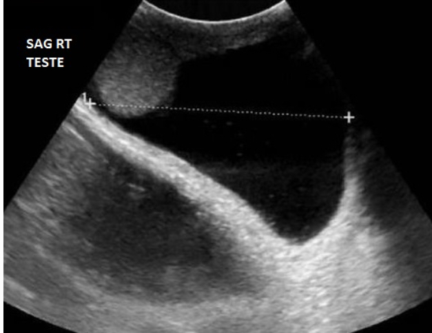 <p>Which measurement on the hydrocele is being assessed on the image?</p><p>A) length </p><p>B) AP </p><p>C) width </p>