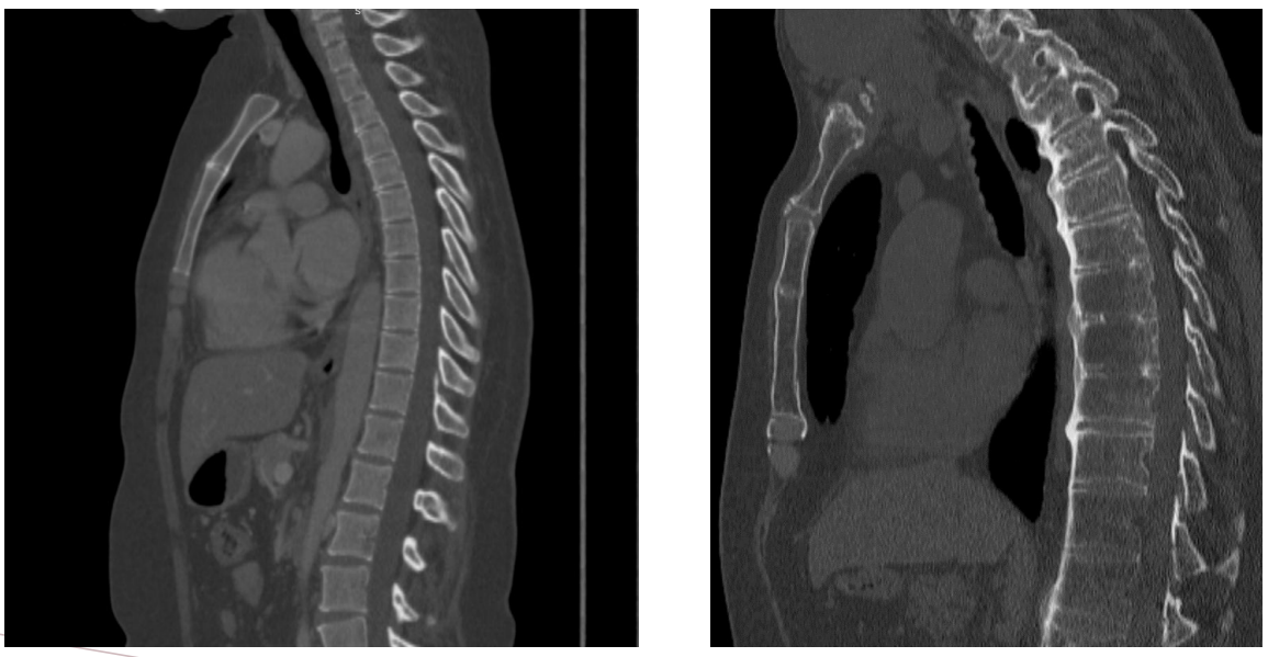 <p>What is this CT bone window imaging presenting?</p>