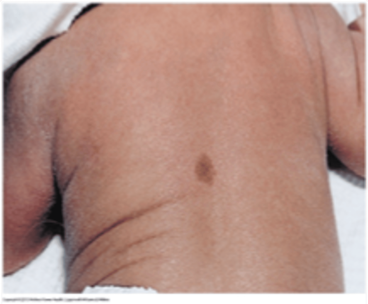 <p>light brown pigmented lesions</p><p>if more than 5 consider pathognomonic for neurological disease</p>