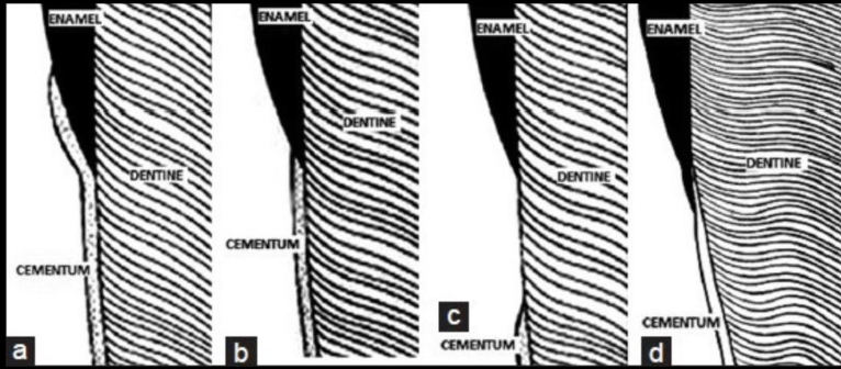 <p>gap (absence of enamel meeting the cementum)</p>