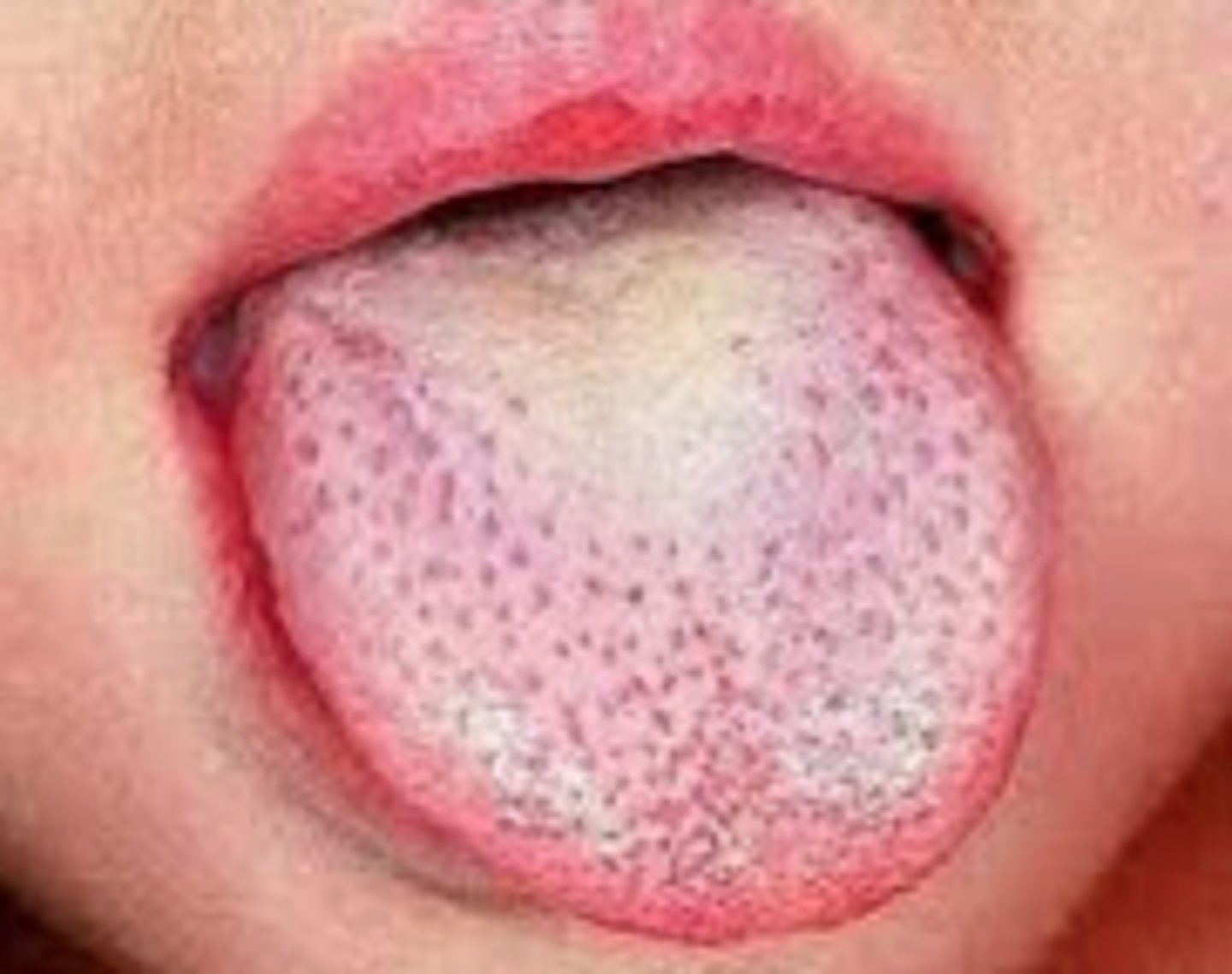 <p>fungiform papillae are red and prominent</p><p>dorsal surface initially has a white coating and then sheds and becomes red</p>