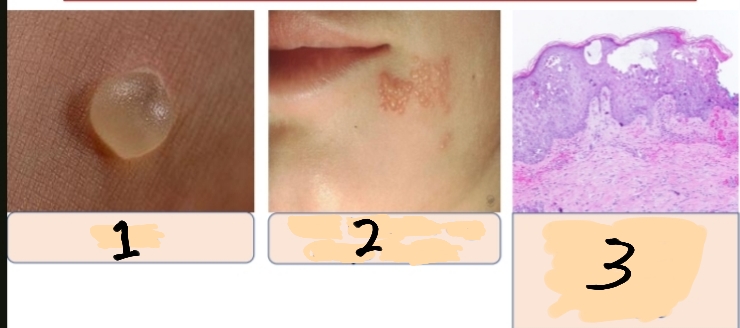 <p>Describe the type of inflammation by providing its name and characteristic feature, its listed causes that are shown in the image 1,2</p><p>And 3 refer to what ?</p>