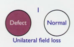 <p>unilateral field loss</p>
