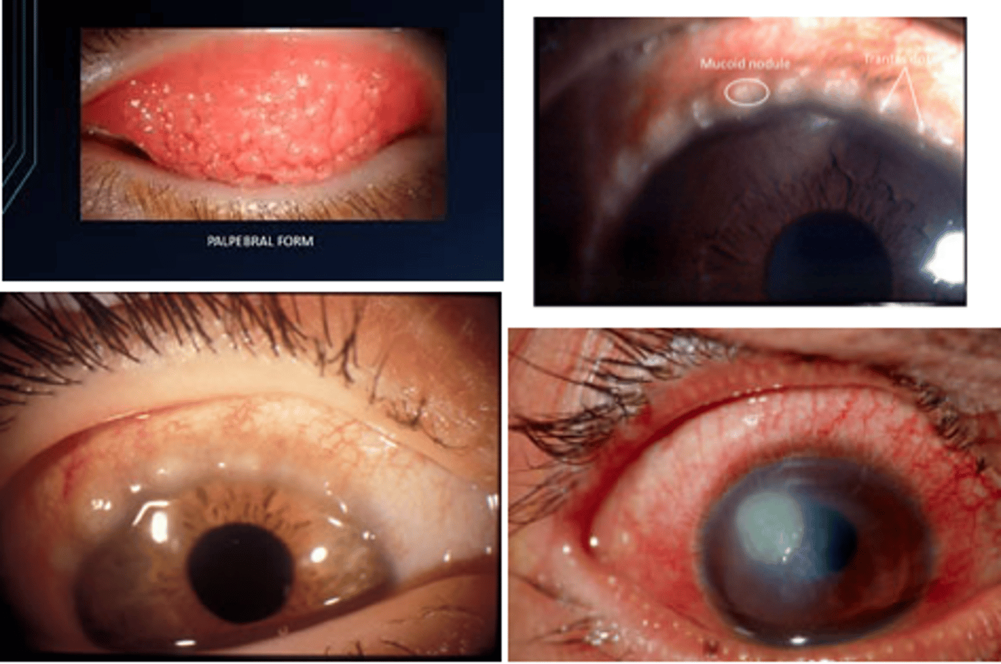 <p>Keratoconjunctivitis - infection of iris, conjunctive that can cause blindness<br>-Dendritic lesions on corneal stain</p>