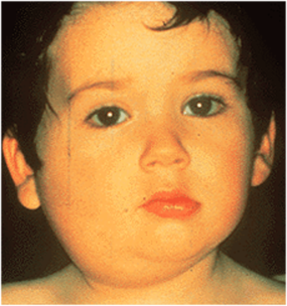 <p>Caused by the paramyxovirus, spread by saliva, no treatment, MMR vaccine.</p>