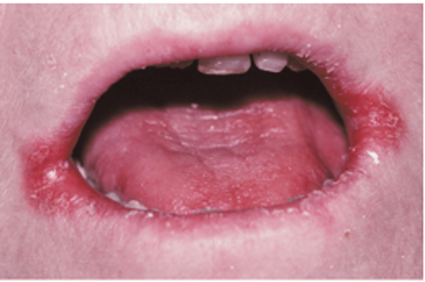 <p>candida infection associated with dentures/drooling</p>