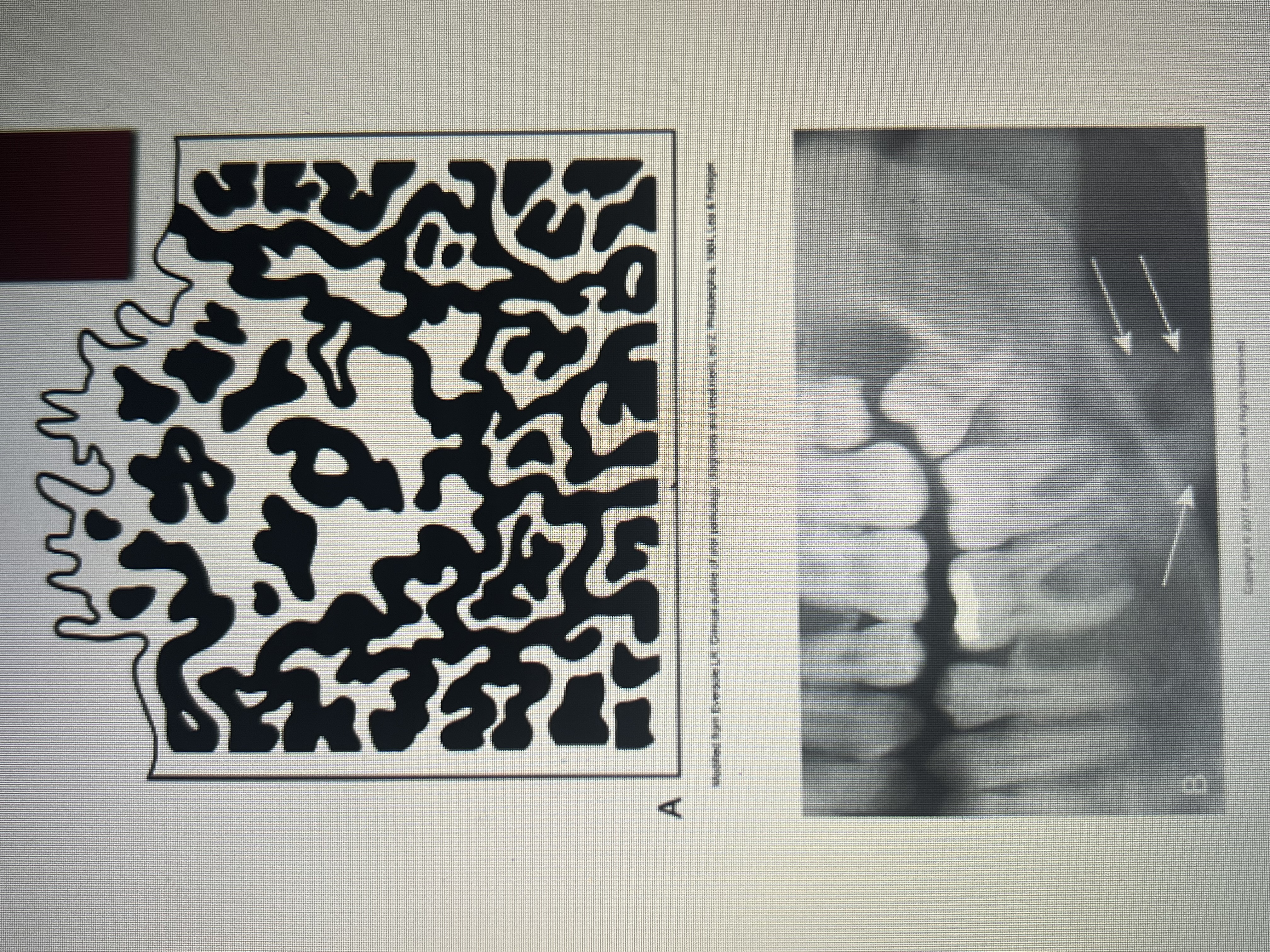 <p>Irregular/Ill-defined opacity</p>