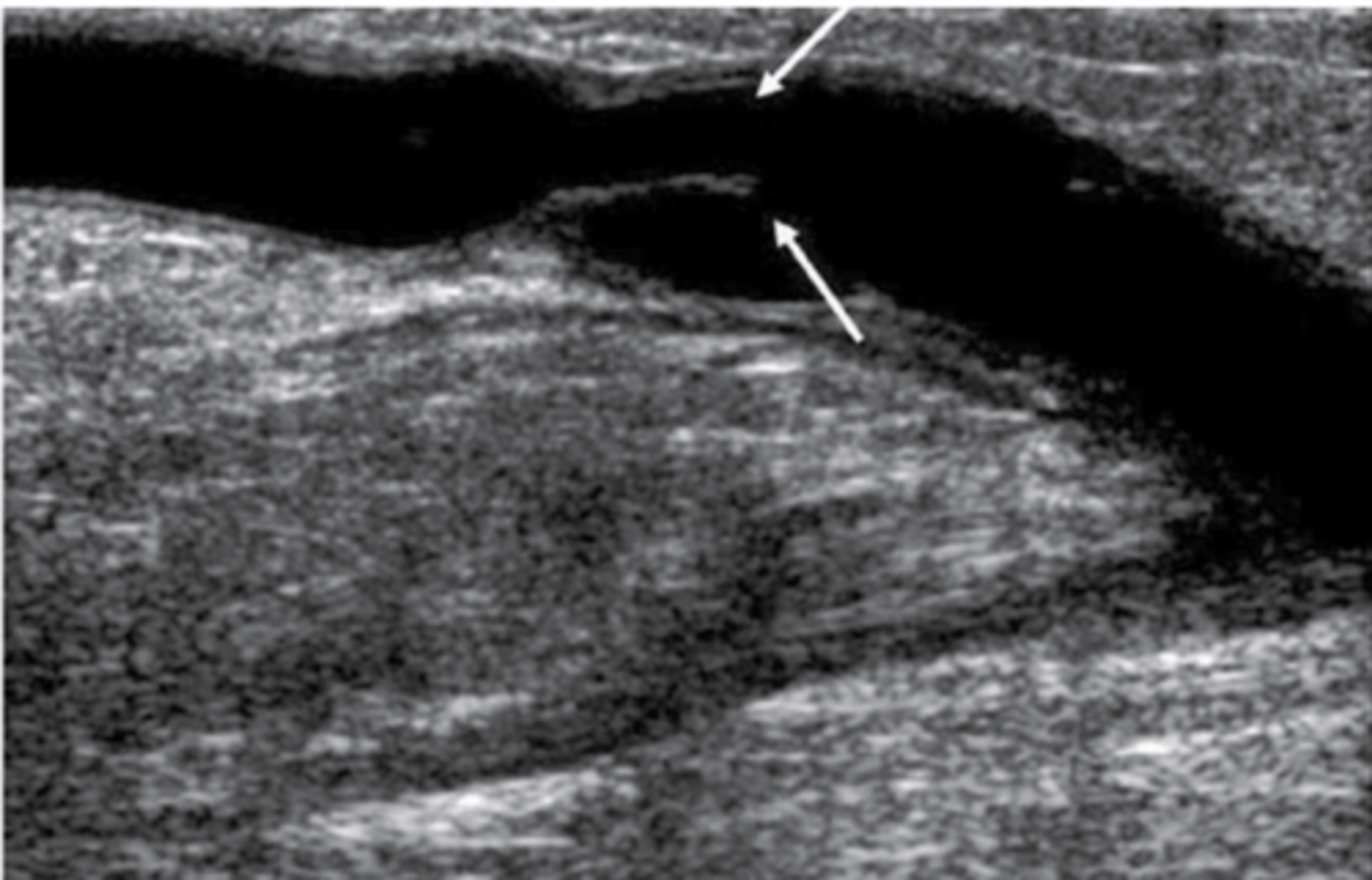 <p>Increased velocities through stenotic area at level of retained materials</p><p>Turbulent post-stenotic zone</p>