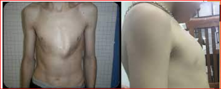 <p>Câu 60: Pectus<span style="color: yellow;"> carina</span>tum là <span style="color: blue;">tên gọi</span> của <span style="color: red;">dị tật lồng ngực</span> nào?<span>&nbsp;</span></p><p class="MsoNormal">A. Lồng ngực <span style="color: green;">hình ức chim</span><span style="font-family: "Segoe UI Symbol", sans-serif;"><span>✓</span></span><span>&nbsp;</span></p><p class="MsoNormal">B. Lồng ngực hình phễu<span>&nbsp;</span></p><p class="MsoNormal">C. Lồng ngực hẹp<span>&nbsp;</span></p><p class="MsoNormal">D. Lồng ngực rộng<span>&nbsp;</span></p>