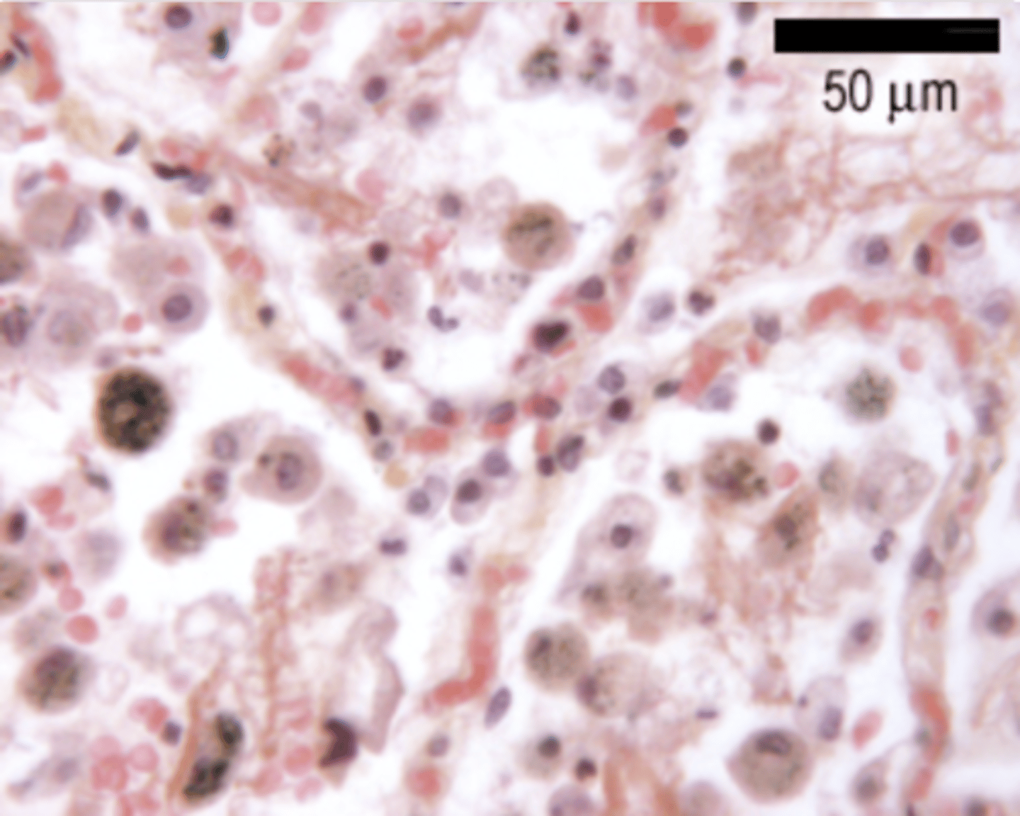 <p>The alveoli become over inflated, and the walls break down. This leads to a decrease in respiratory function, and breathlessness.</p>